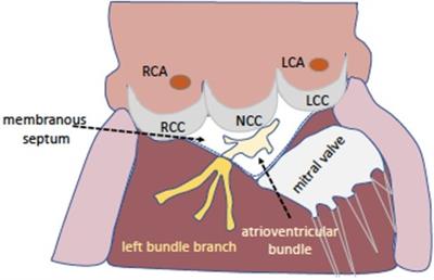 Cusp-overlap view reduces conduction disturbances and permanent pacemaker implantation after transcatheter aortic valve replacement even with balloon-expandable and mechanically-expandable heart valves